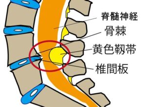 脊椎管狭窄症（脊柱管狭窄症）の症状と原因