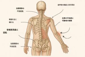 【例】左股関節形成不全から右肩関節までの連鎖
