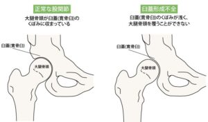 股関節形成不全が体全体に与える影響とは