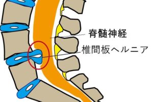 椎間板ヘルニアの特徴